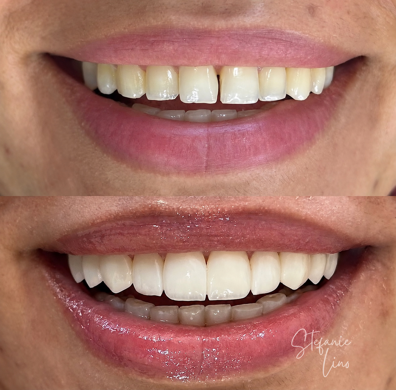 Resultado de tratamento odontológico, antes e depois